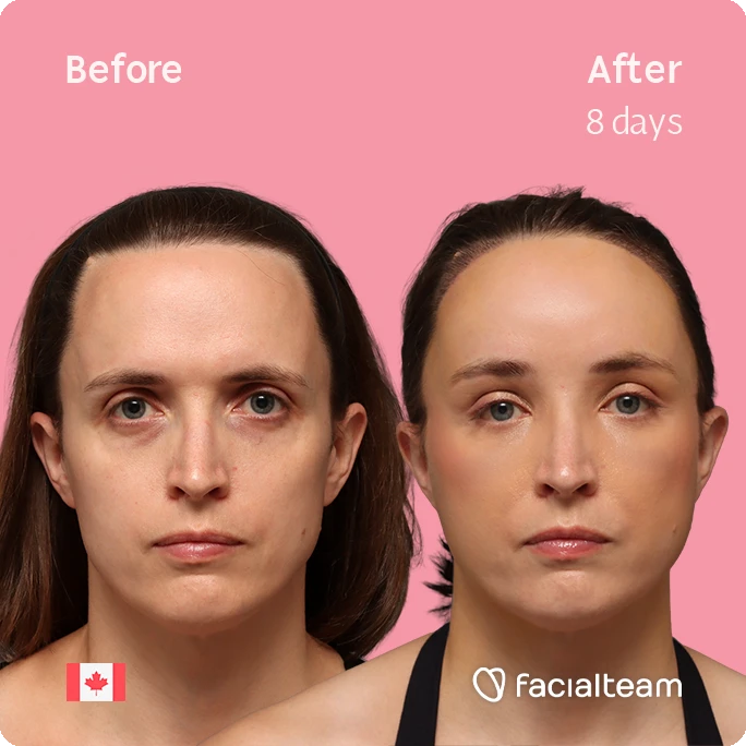 Front square image of FFS patient Erin showing the results before-after with Facialteam consisting of Forehead with SHT.