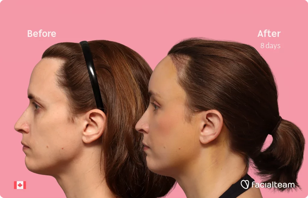 Side left image of FFS patient Erin showing the results before-after with Facialteam consisting of Forehead with SHT.