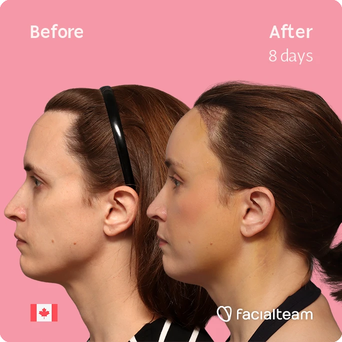 Side left square image of FFS patient Erin showing the results before-after with Facialteam consisting of Forehead with SHT.