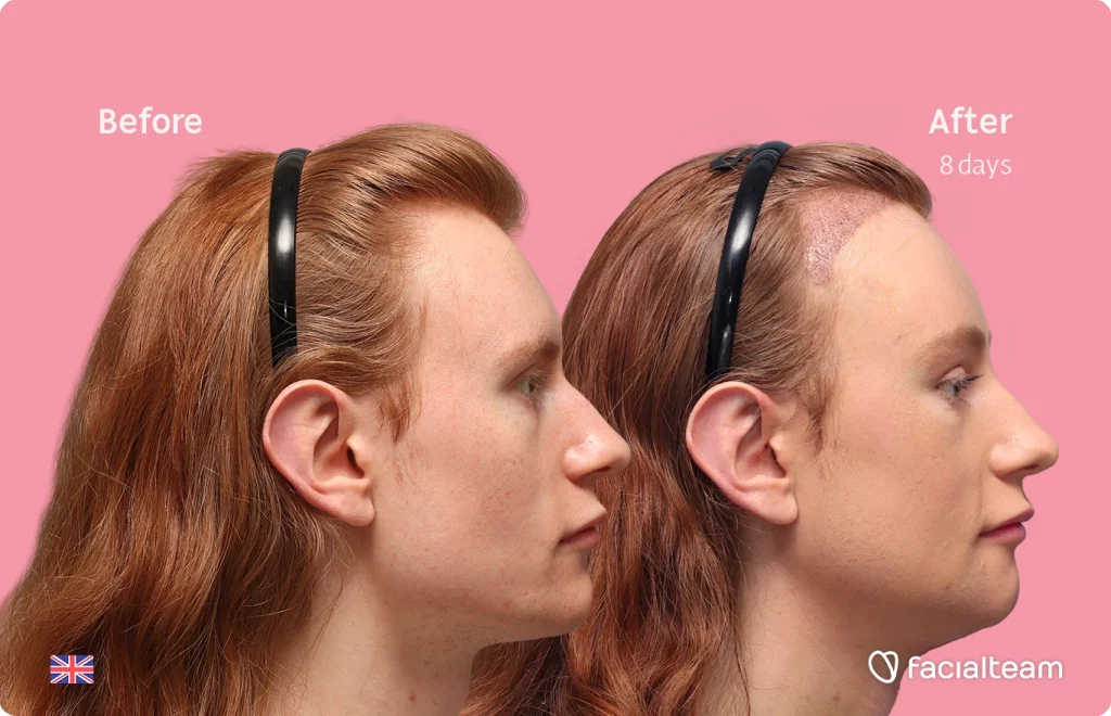 Side right image of FFS patient Annah showing the results before and after with Facialteam, consisting of forehead feminization with simultaneous hair transplant (SHT), chin recontouring, jaw contouring, and tracheal shave.