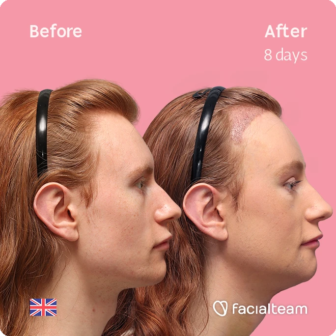 Side right square image of FFS patient Annah showing the results before and after with Facialteam, consisting of forehead feminization with simultaneous hair transplant (SHT), chin recontouring, jaw contouring, and tracheal shave.