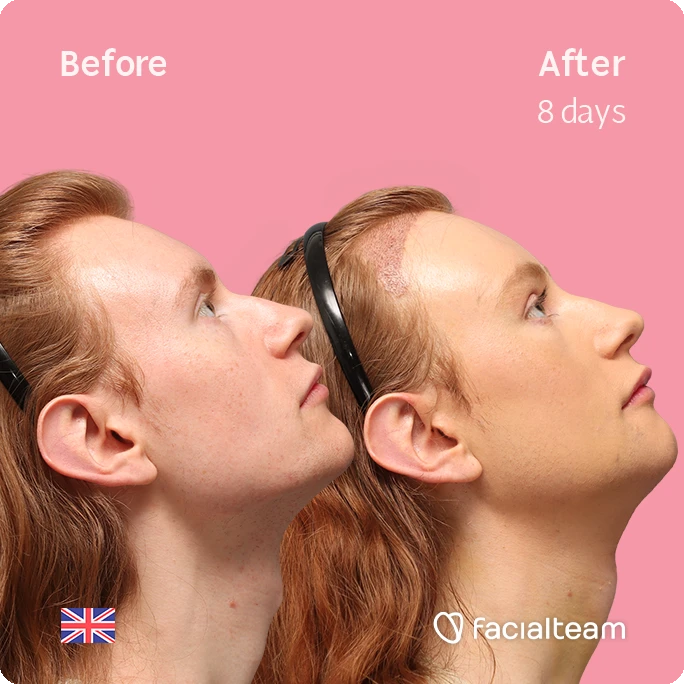 Side right up square image of FFS patient Annah showing the results before and after with Facialteam, consisting of forehead feminization with simultaneous hair transplant (SHT), chin recontouring, jaw contouring, and tracheal shave.