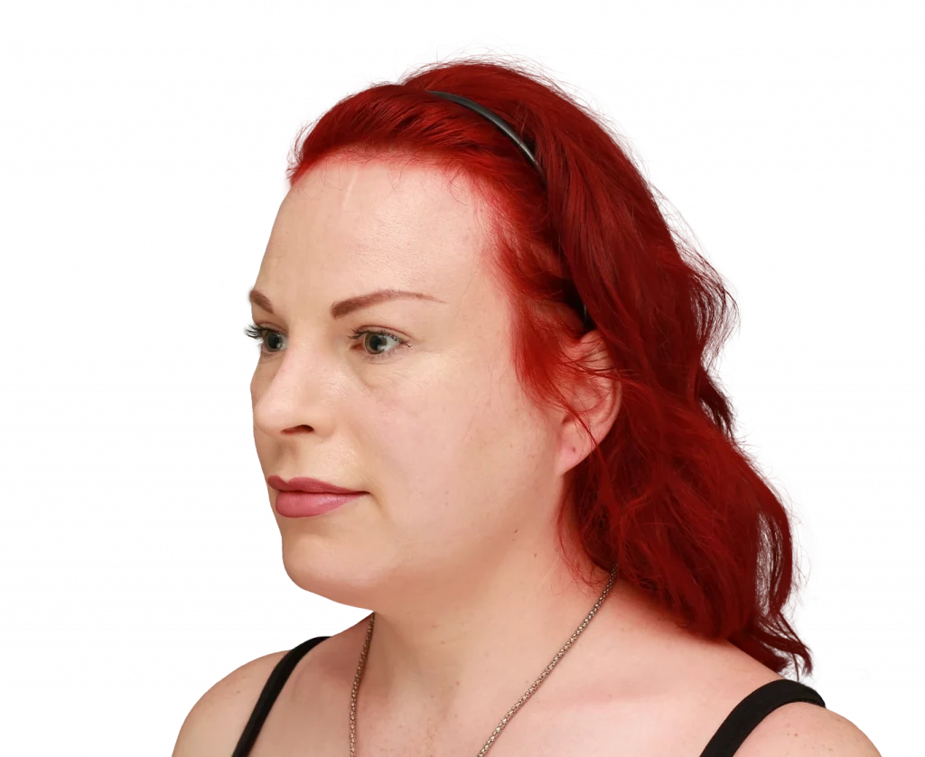 Angled left profile photo of Alexis after surgery.