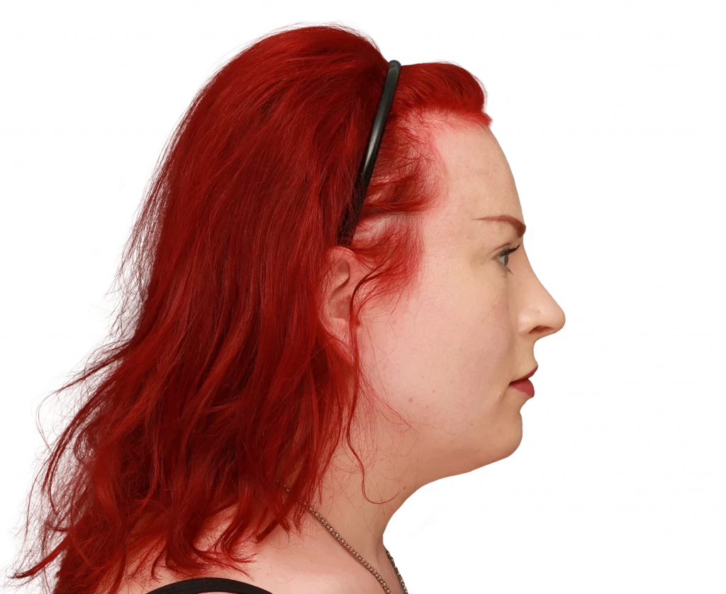 Side right profile photo of Alexis after surgery.