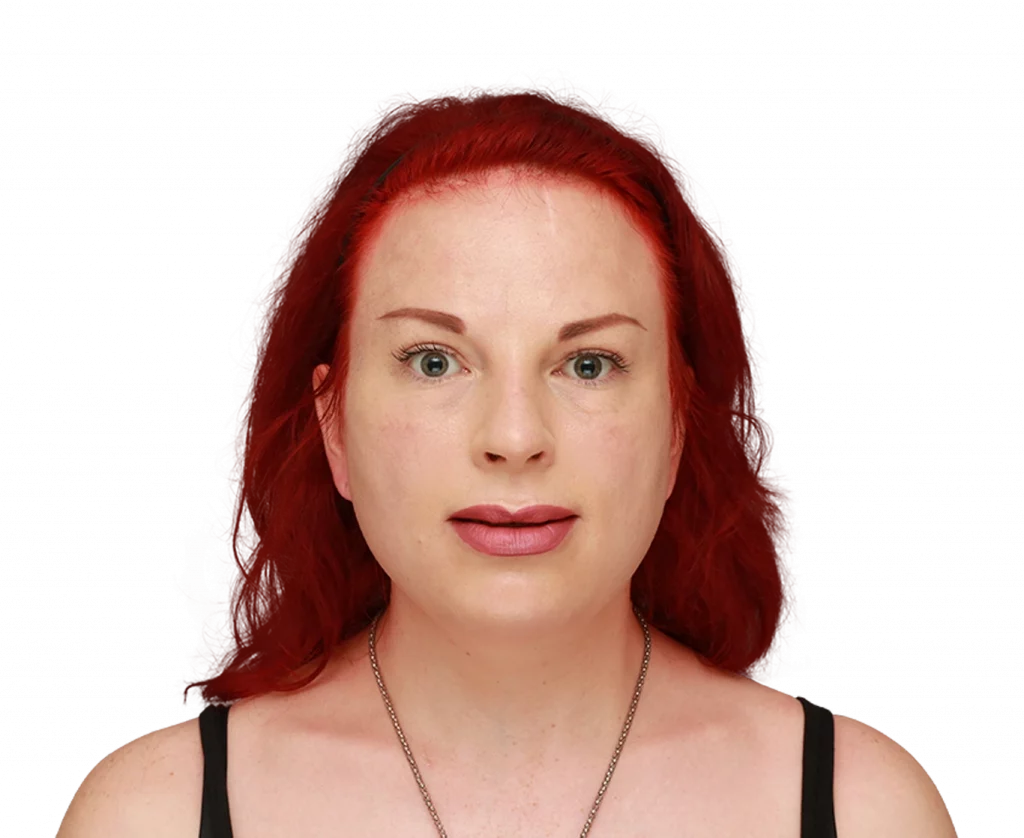 Frontal profile photo of Alexis after surgery.