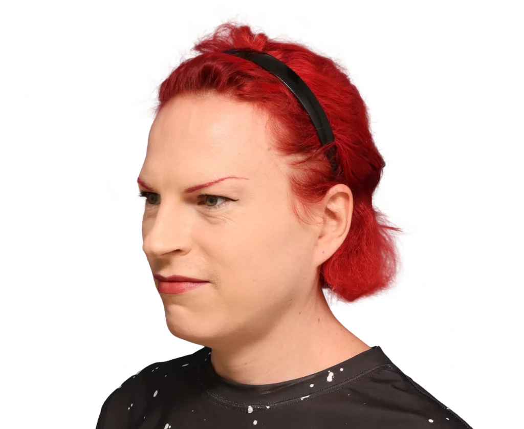 Angled left profile photo of Alexis before surgery.