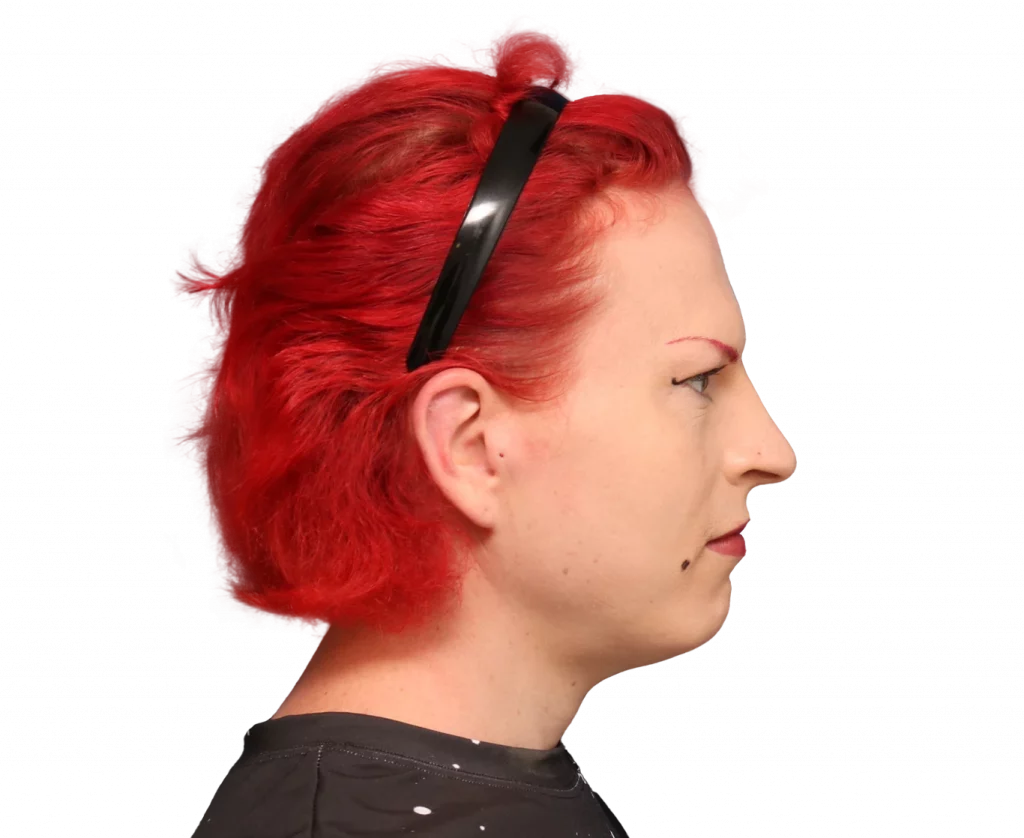 Side right profile photo of Alexis before surgery.