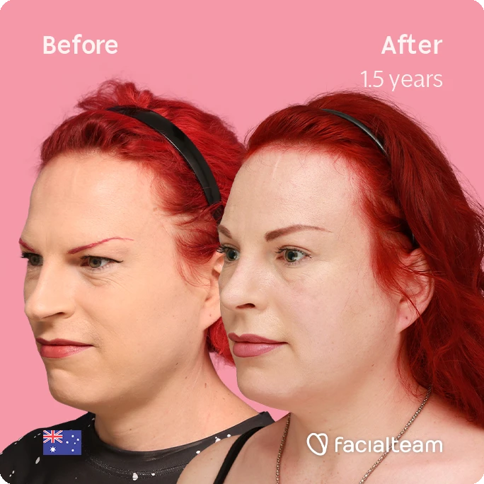 Angled left square image of FFS patient Alexis showing the results before-after with Facialteam consisting of forehead and rhinoplasty feminization surgery.