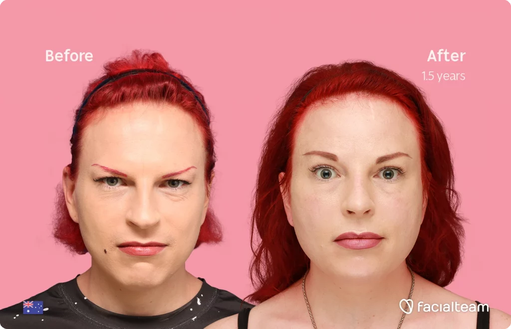 Frontal image of FFS patient Alexis showing the results before-after with Facialteam consisting of forehead and rhinoplasty feminization surgery.