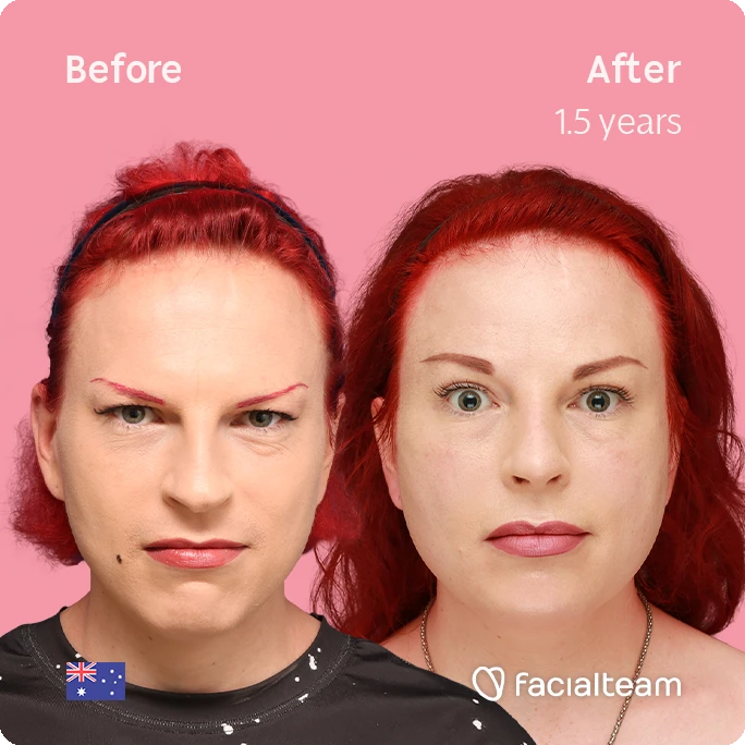 Frontal square image of FFS patient Alexis showing the results before-after with Facialteam consisting of forehead and rhinoplasty feminization surgery.