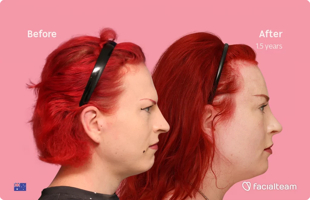 Side right image of FFS patient Alexis showing the results before-after with Facialteam consisting of forehead and rhinoplasty feminization surgery.