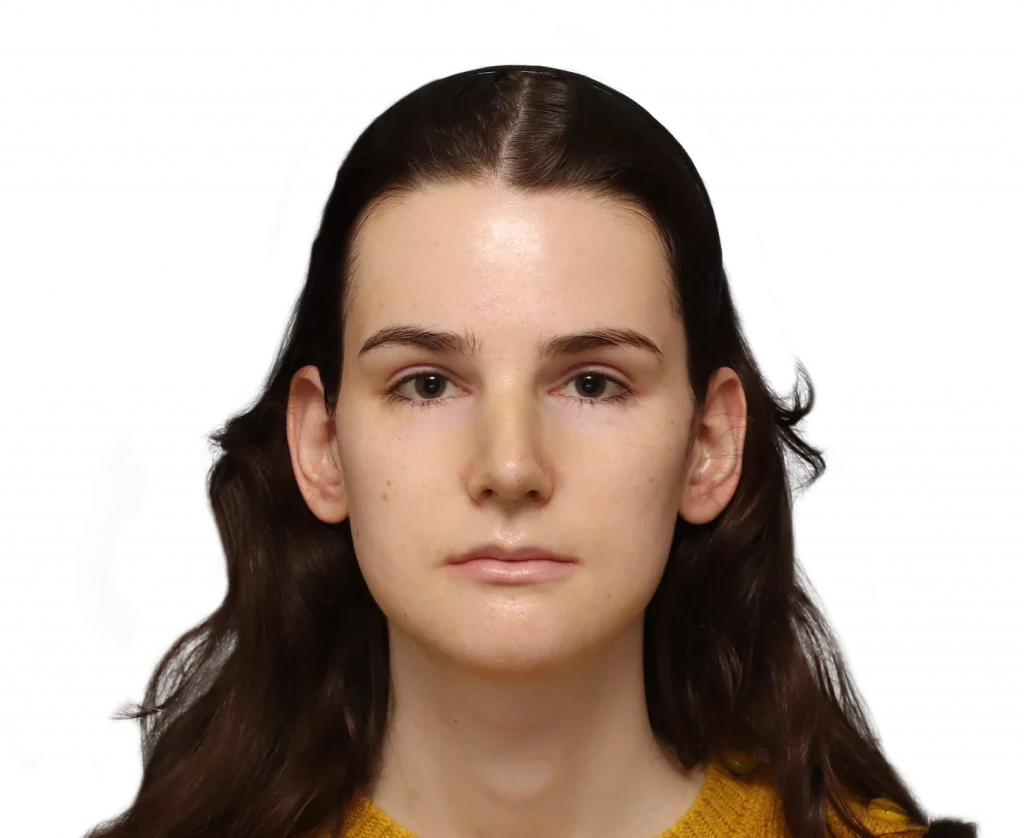 Frontal profile photo of Lena after surgery.