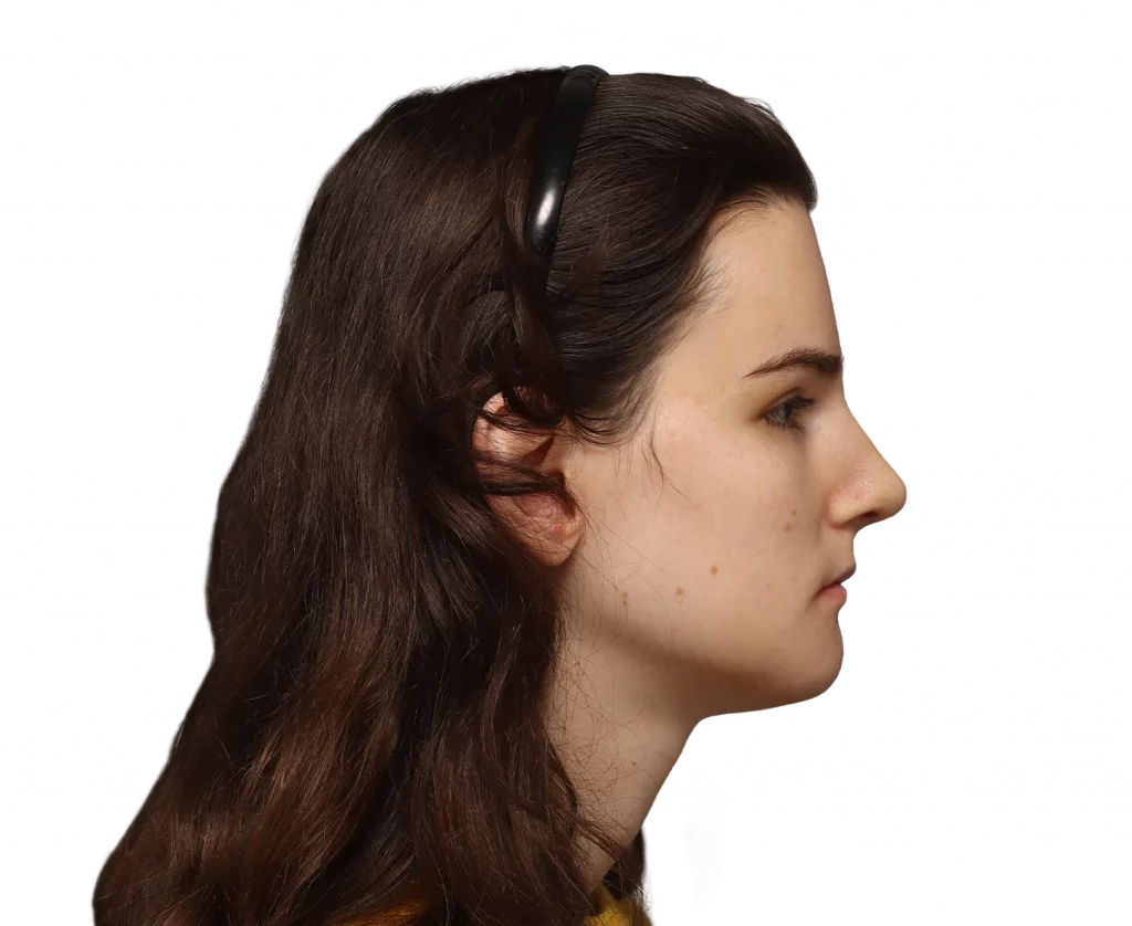 Side right profile photo of Lena after surgery.