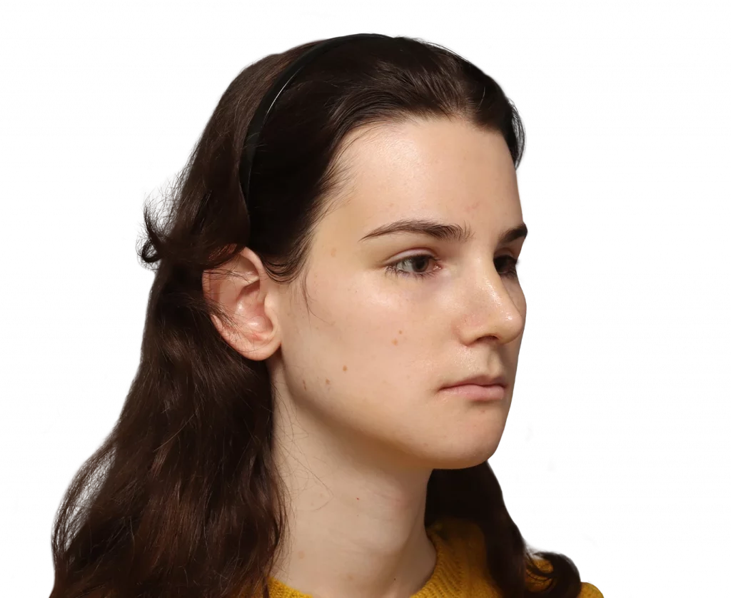 Angled right profile photo of Lena after surgery.