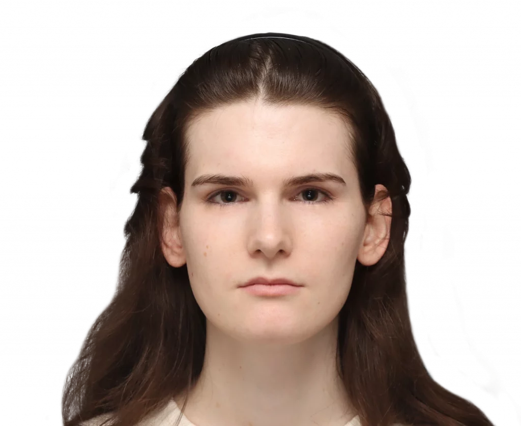 Frontal profile photo of Lena before surgery.