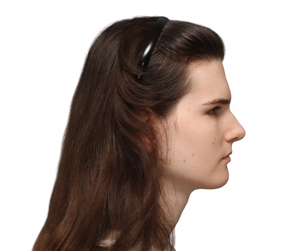 Side right profile photo of Lena before surgery.