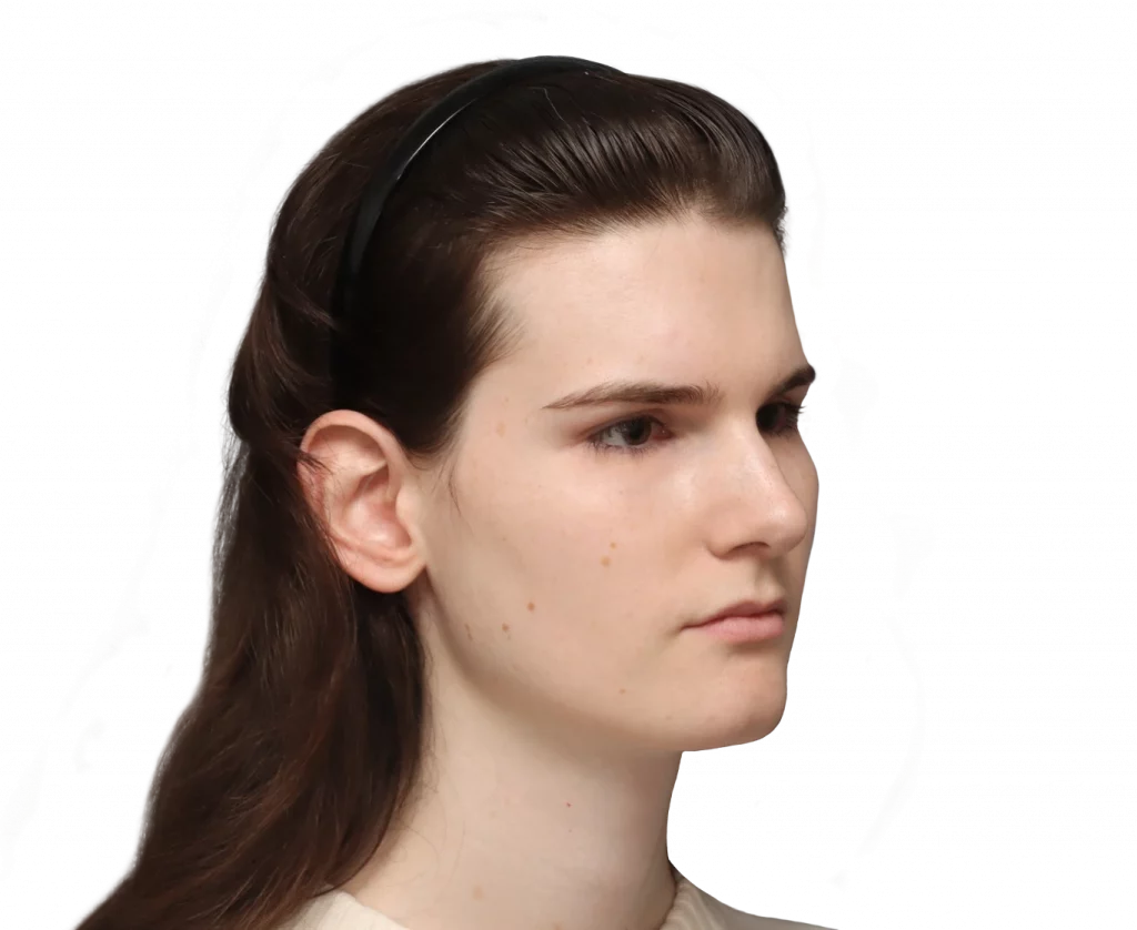 Angled right profile photo of Lena before surgery.