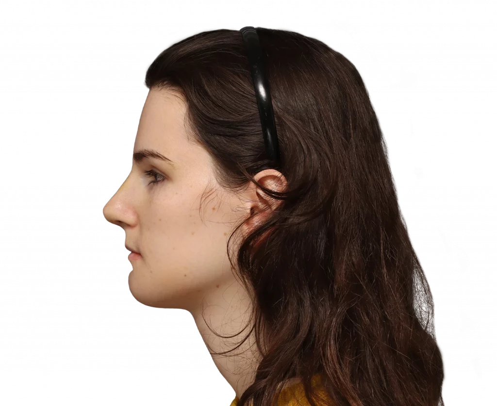 Side left profile photo of Lena after surgery.