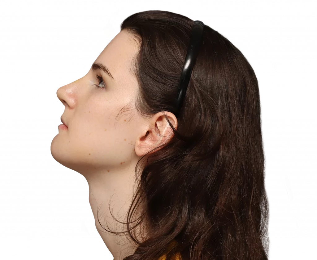 Side up left profile photo of Lena after surgery.