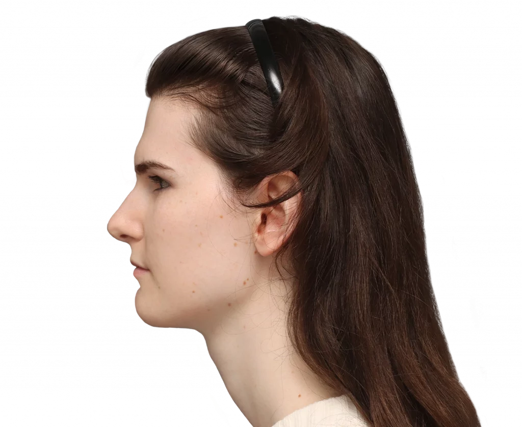 Side left profile photo of Lena before surgery.