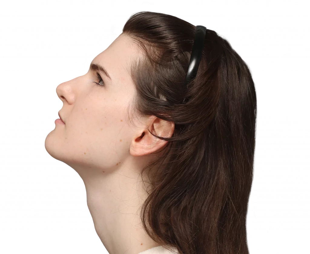 Side up left profile photo of Lena before surgery.