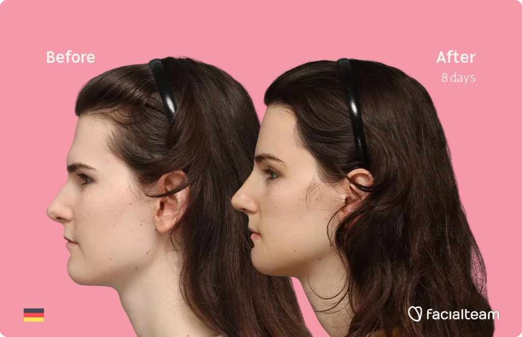 Side left image of FFS patient Lena showing the results before-after with Facialteam consisting of forehead, rhinoplasty, chin and jaw feminization surgery.