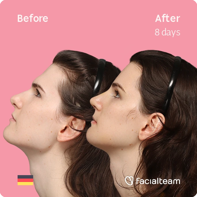 Side up left square image of FFS patient Lena showing the results before-after with Facialteam consisting of forehead, rhinoplasty, chin and jaw feminization surgery.