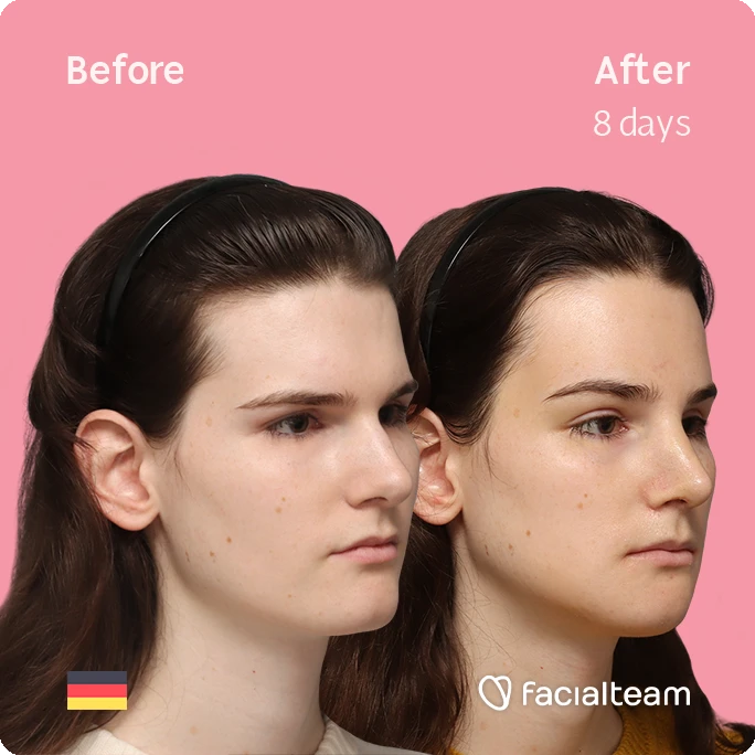 Angled right square image of FFS patient Lena showing the results before-after with Facialteam consisting of forehead, rhinoplasty, chin and jaw feminization surgery.