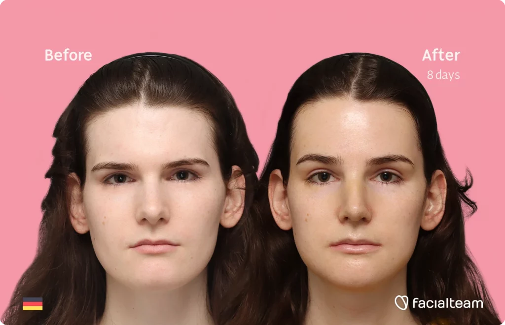 Frontal image of FFS patient Lena showing the results before-after with Facialteam consisting of forehead, rhinoplasty, chin and jaw feminization surgery.
