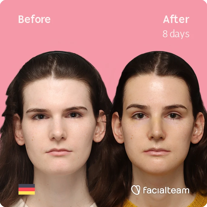 Frontal square image of FFS patient Lena showing the results before-after with Facialteam consisting of forehead, rhinoplasty, chin and jaw feminization surgery.