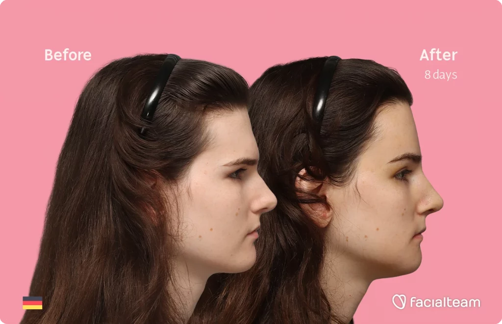 Side right image of FFS patient Lena showing the results before-after with Facialteam consisting of forehead, rhinoplasty, chin and jaw feminization surgery.