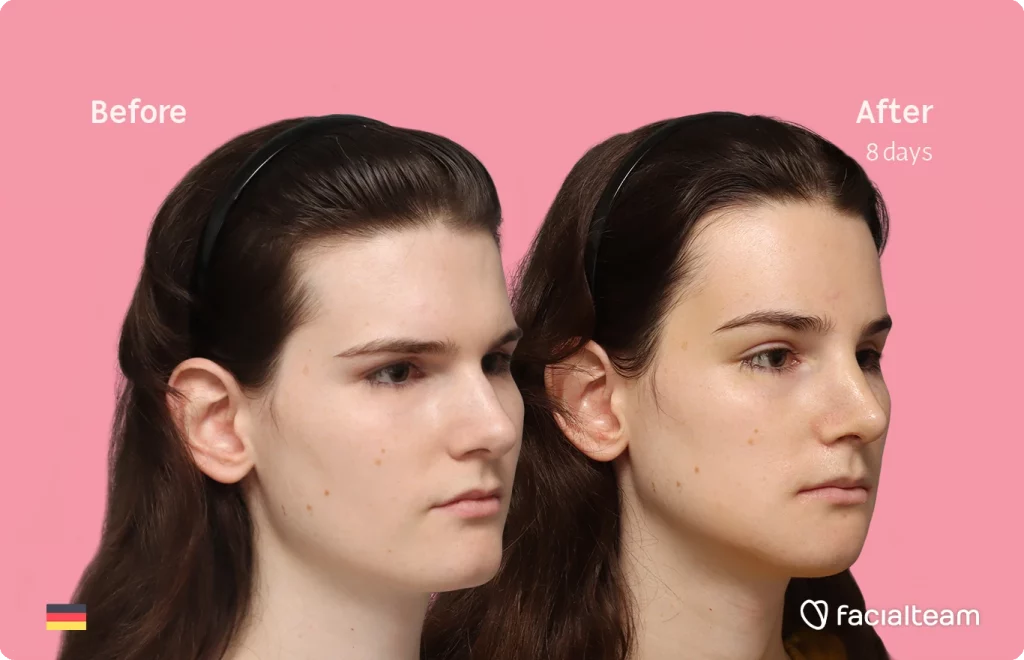 Angled right image of FFS patient Lena showing the results before-after with Facialteam consisting of forehead, rhinoplasty, chin and jaw feminization surgery.