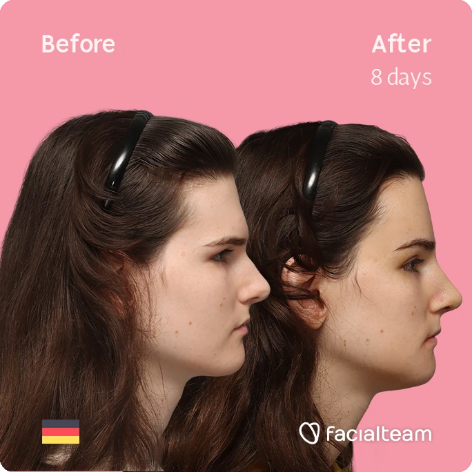 Side right square image of FFS patient Lena showing the results before-after with Facialteam consisting of forehead, rhinoplasty, chin and jaw feminization surgery.