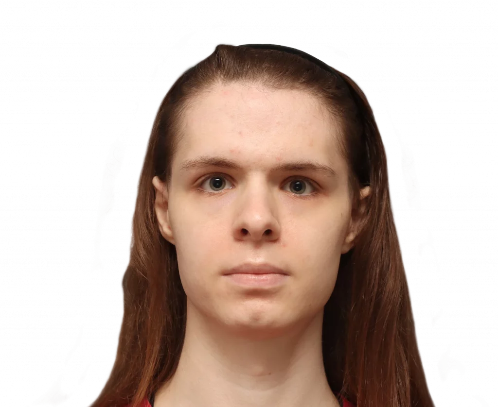 Frontal profile photo of Robert before surgery.