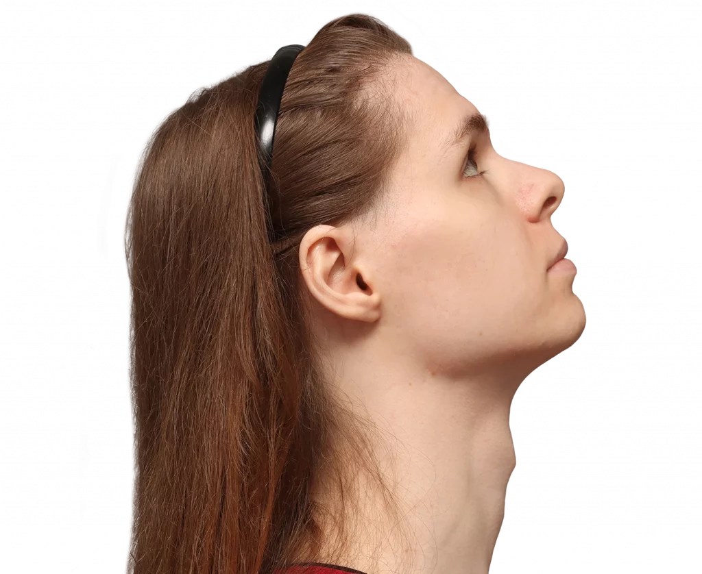 Side right up profile photo of Robert before surgery.