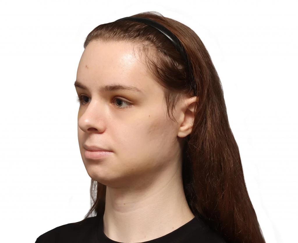 Angled left profile photo of Robert after surgery.