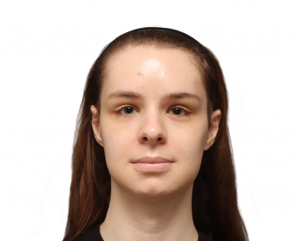 Forntal profile photo of Robert after surgery.