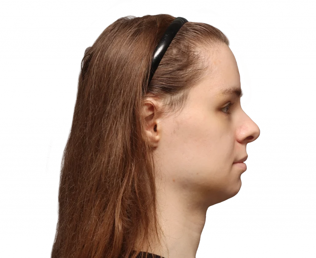 Side right profile photo of Robert after surgery.