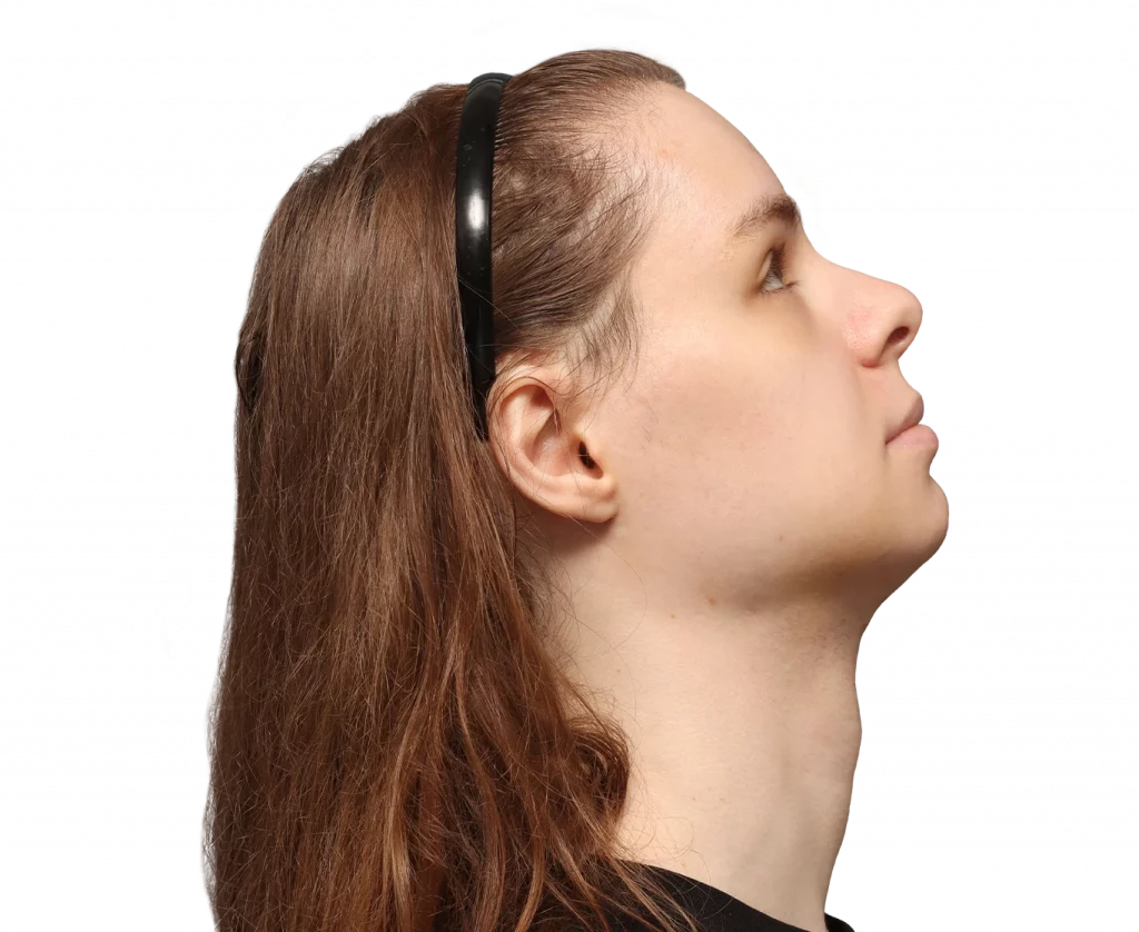 Side right up profile photo of Robert after surgery.