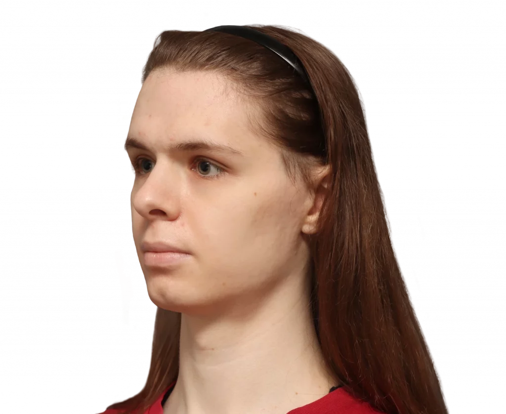 Angled left profile photo of Robert before surgery.