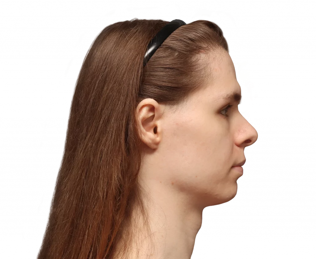 Side right profile photo of Robert before surgery.