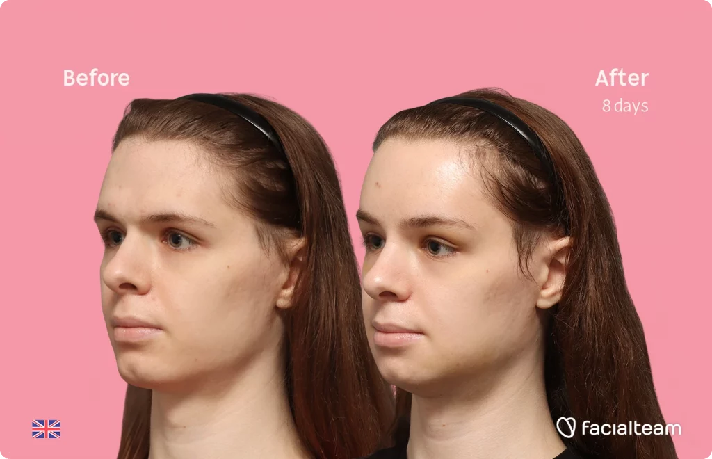 Angled left image of FFS patient Robert showing the results before-after with Facialteam consisting of forehead, tracheal shave and chin feminization surgery.