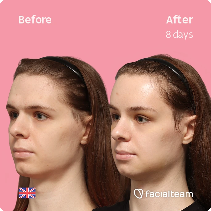 Angled left square image of FFS patient Robert showing the results before-after with Facialteam consisting of forehead, tracheal shave and chin feminization surgery.
