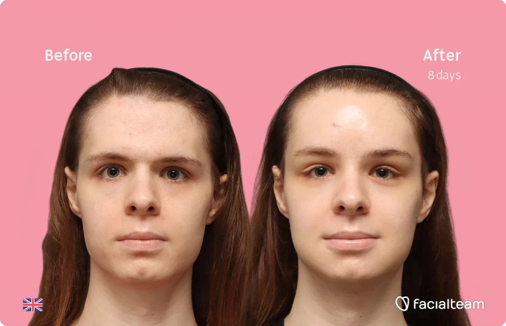 Frontal square image of FFS patient Robert showing the results before-after with Facialteam consisting of forehead, tracheal shave and chin feminization surgery.