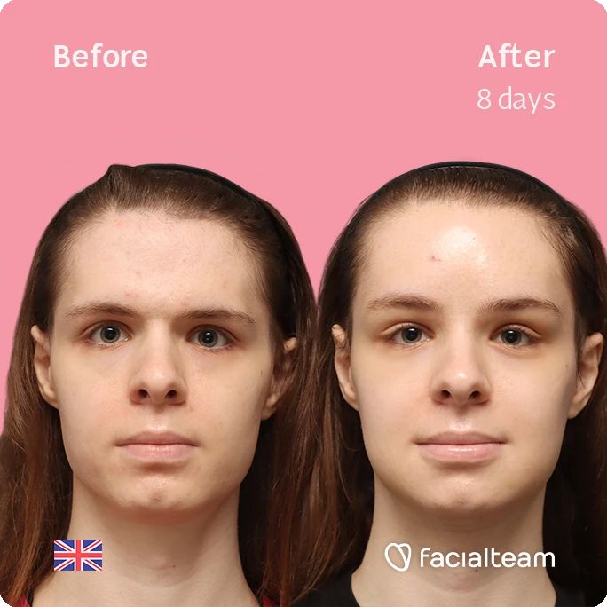 Frontal square image of FFS patient Robert showing the results before-after with Facialteam consisting of forehead, tracheal shave and chin feminization surgery.