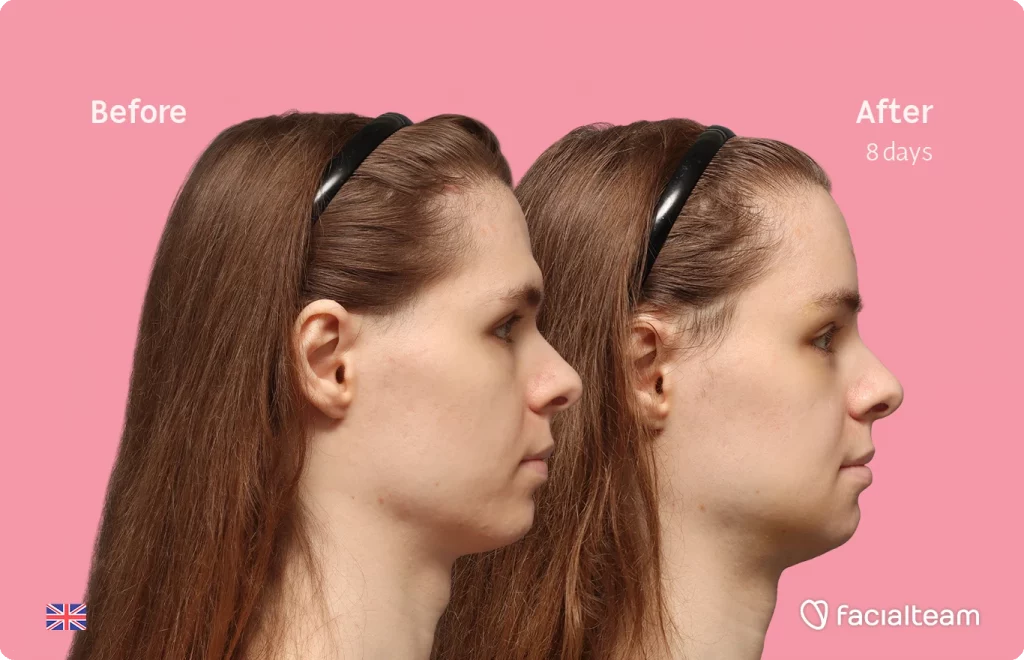 Side right image of FFS patient Robert showing the results before-after with Facialteam consisting of forehead, tracheal shave and chin feminization surgery.