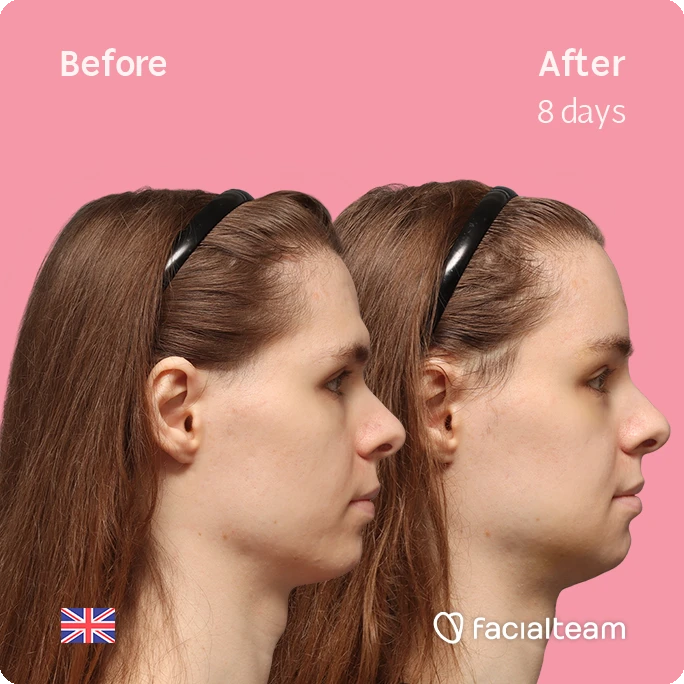 Side right square image of FFS patient Robert showing the results before-after with Facialteam consisting of forehead, tracheal shave and chin feminization surgery.
