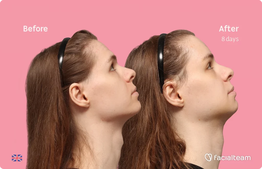 Side right up image of FFS patient Robert showing the results before-after with Facialteam consisting of forehead, tracheal shave and chin feminization surgery.