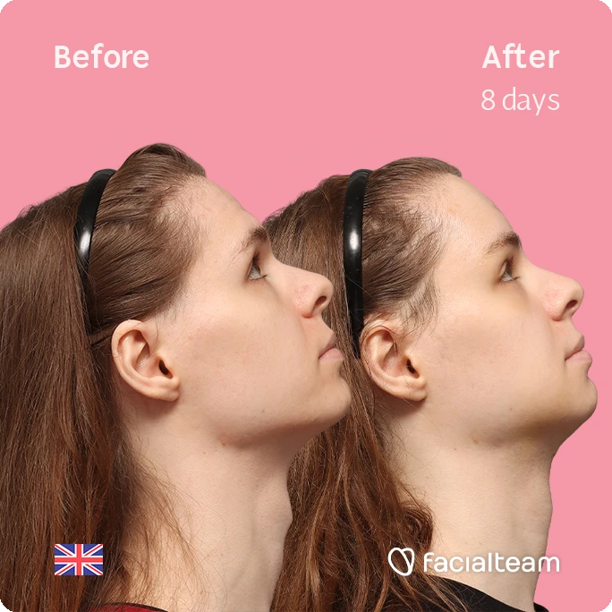 Side right up square image of FFS patient Robert showing the results before-after with Facialteam consisting of forehead, tracheal shave and chin feminization surgery.
