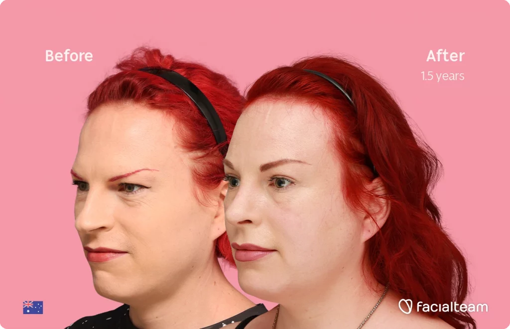 Angled left image of FFS patient Alexis showing the results before-after with Facialteam consisting of forehead and rhinoplasty feminization surgery.